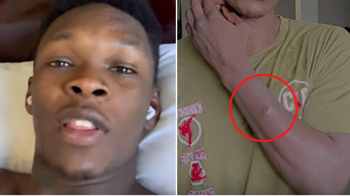 Israel Adesanya Responds To Reports He Has A Staph Infection Ahead Of Ufc 248 Sportbible